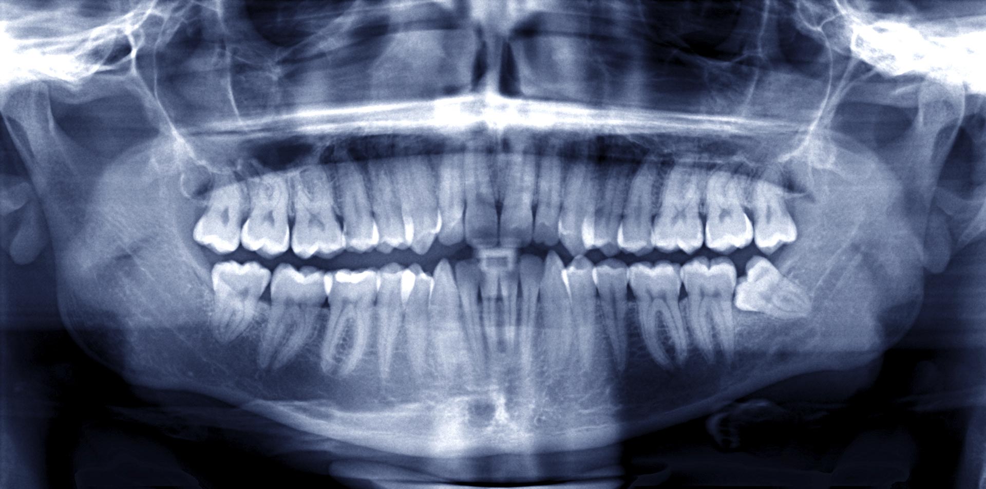 Radiographie panoramique au centre de santé dentaire Al denté St Jérôme.