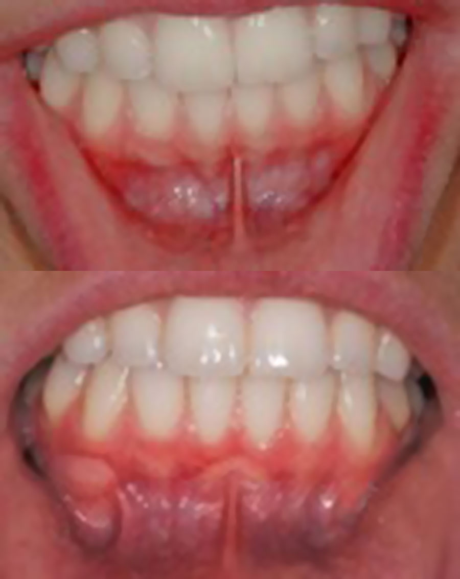 La frénectomie au Centre de santé dentaire Al Denté à St Jérôme.