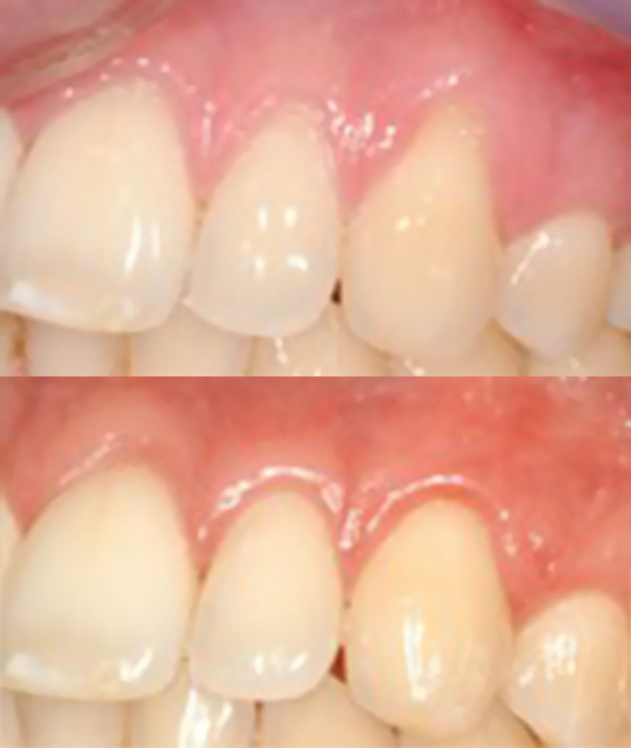 Recouvrement de la gencive au centre de santé dentaire Al Denté à St Jérôme.