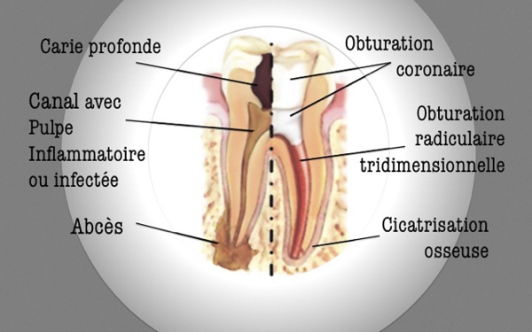 Traitement de canal dans la clinique dentaire Al Denté à St Jérôme.