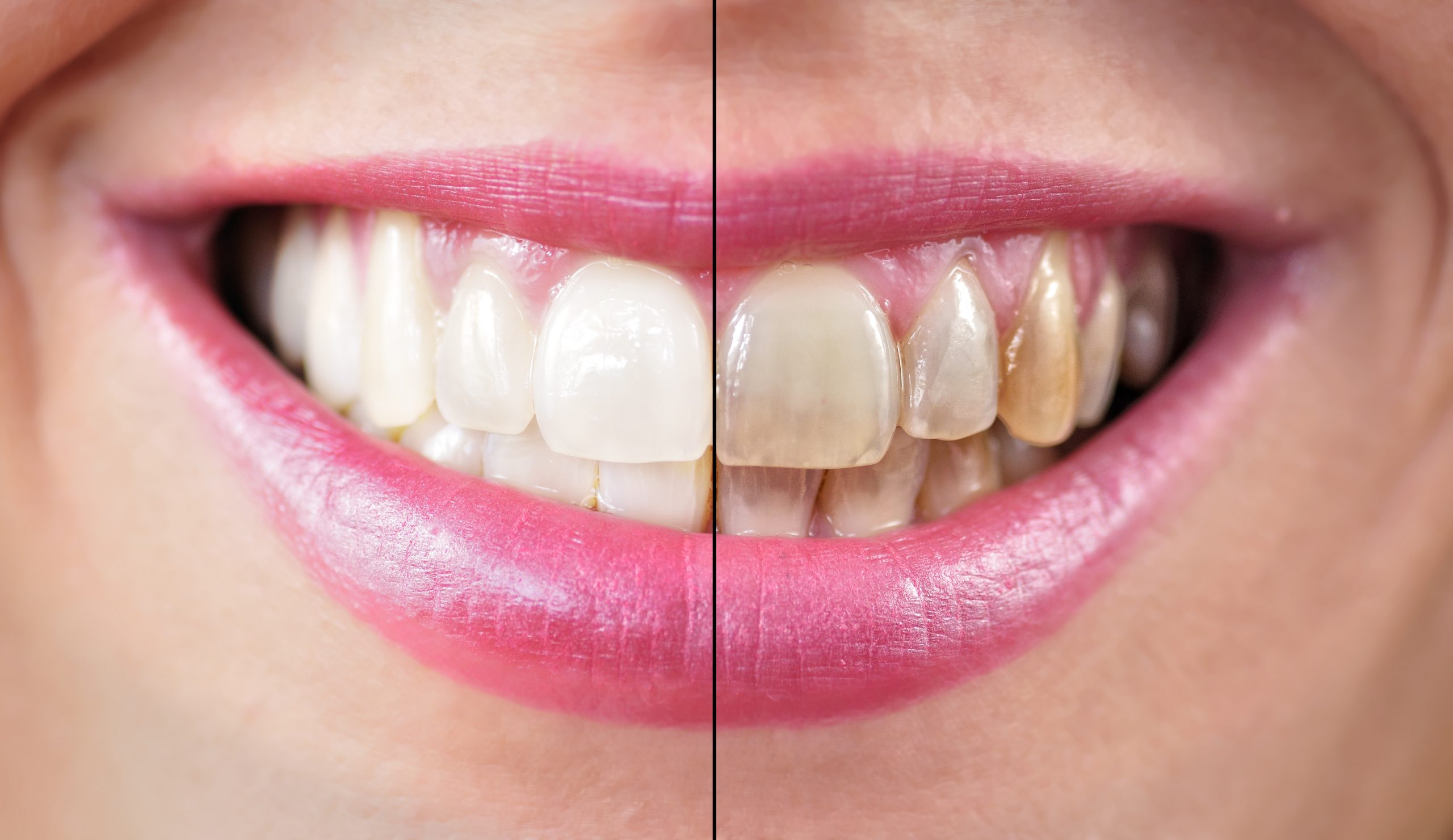 Le tabagisme favorise la maladie de gencive et les caries.