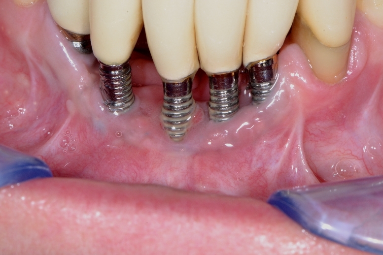 What Is Peri implantitis Centre De Sant Dentaire Al Dente St J r me