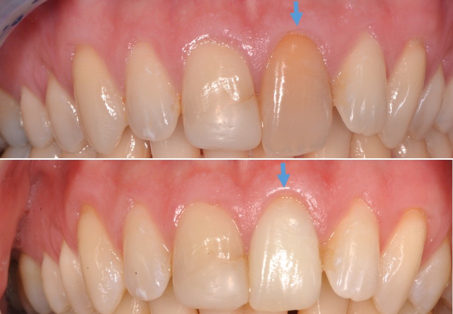 Traitements de blanchiment des dents au centre de santé dentaire Al Denté à St-Jérôme