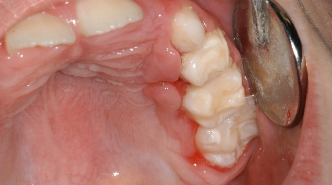 La gingivostomatite herpétique primaire.