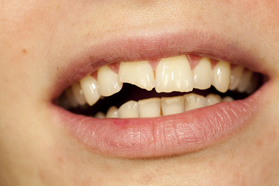 Vous avez reçu un coup et avez peur pour vos dents?