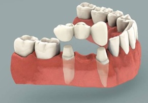 A bridge is a dental restoration that replaces one or more missing teeth.