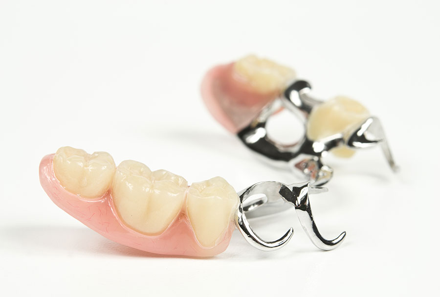 La prothèse partielle est composée d’une ou de plusieurs dents artificielles.