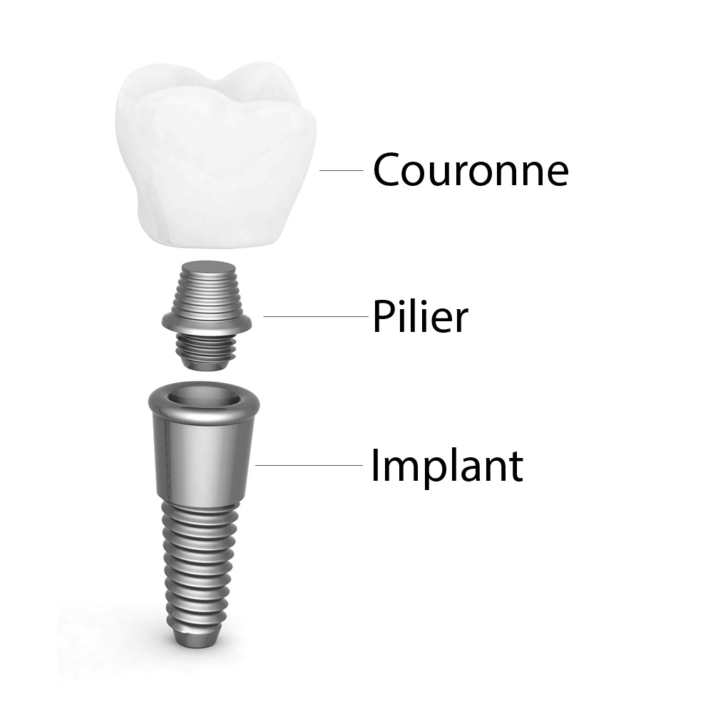 L’implantologie, une branche de la dentisterie qui se consacre aux implants dentaires.