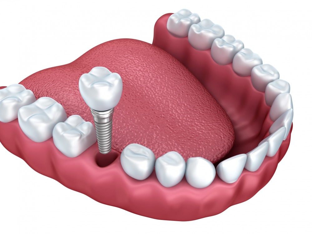 Les avantages des implants dentaires par rapport aux prothèses amovibles.