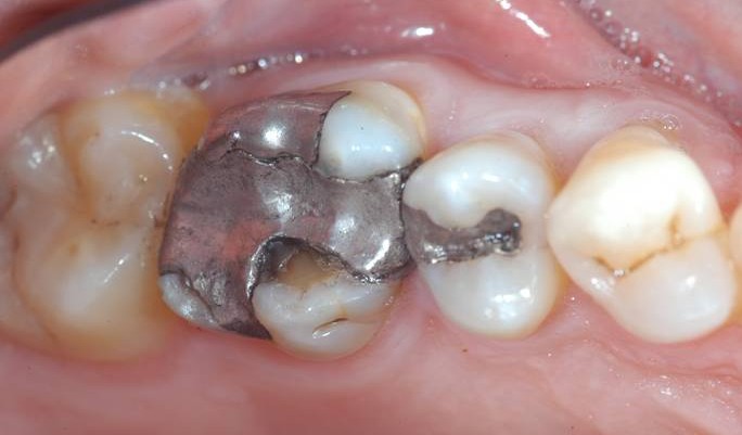 Why do dentists at Al Dente not use dental amalgam?
