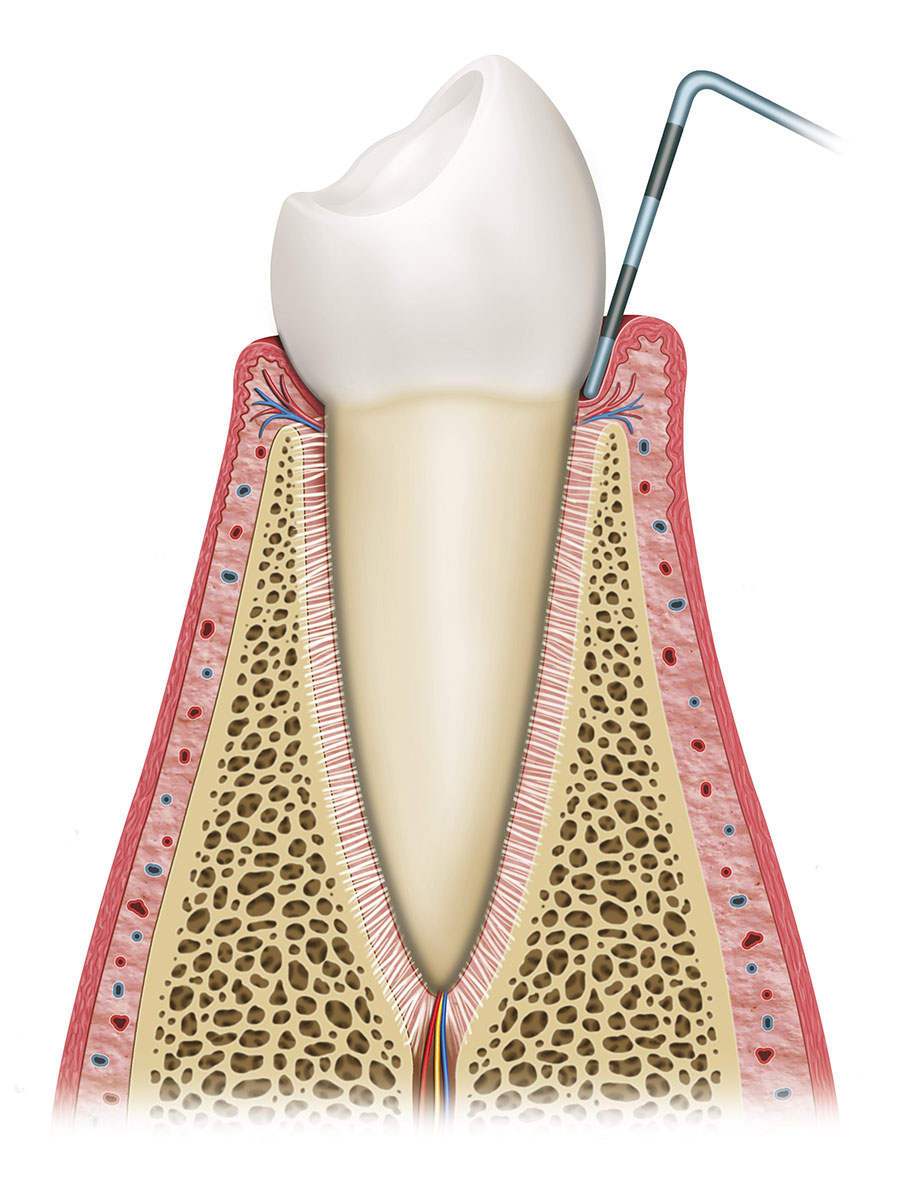 La parodontite est une maladie qui entraîne la destruction des tissus qui supportent les dents.