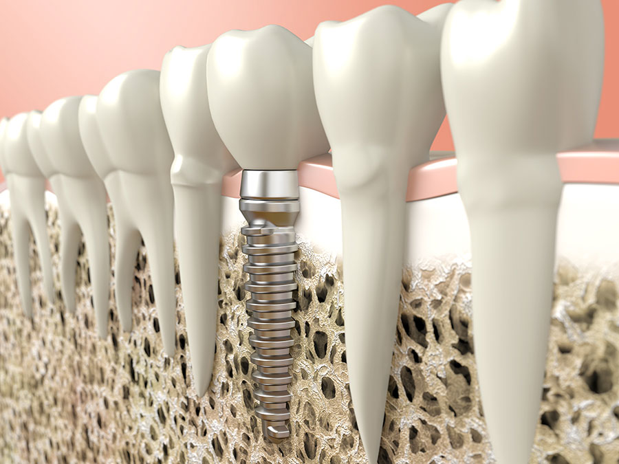 La pose d’implants dentaires dans l’os de la mâchoire.